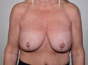 Before Image: Breast Implant Removal with Lift