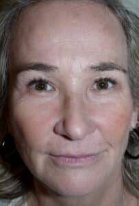After Image: Forehead Lift