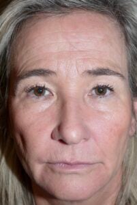 Before Image: Forehead Lift