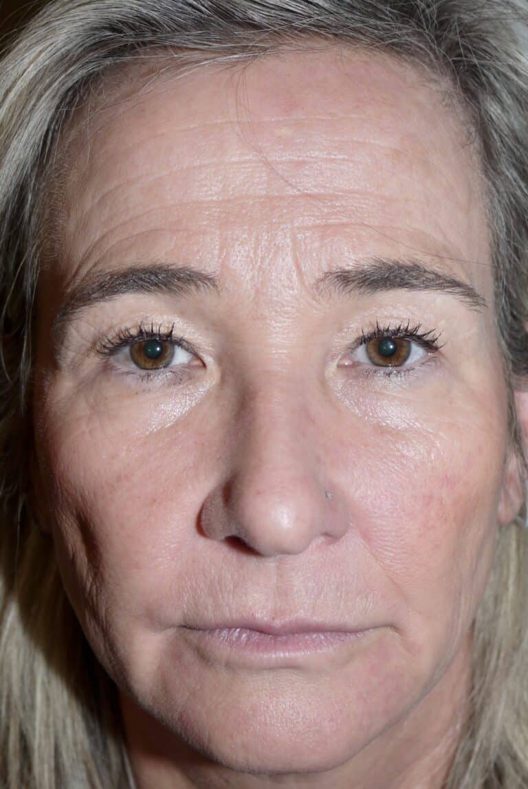 Before Image: Forehead Lift - front