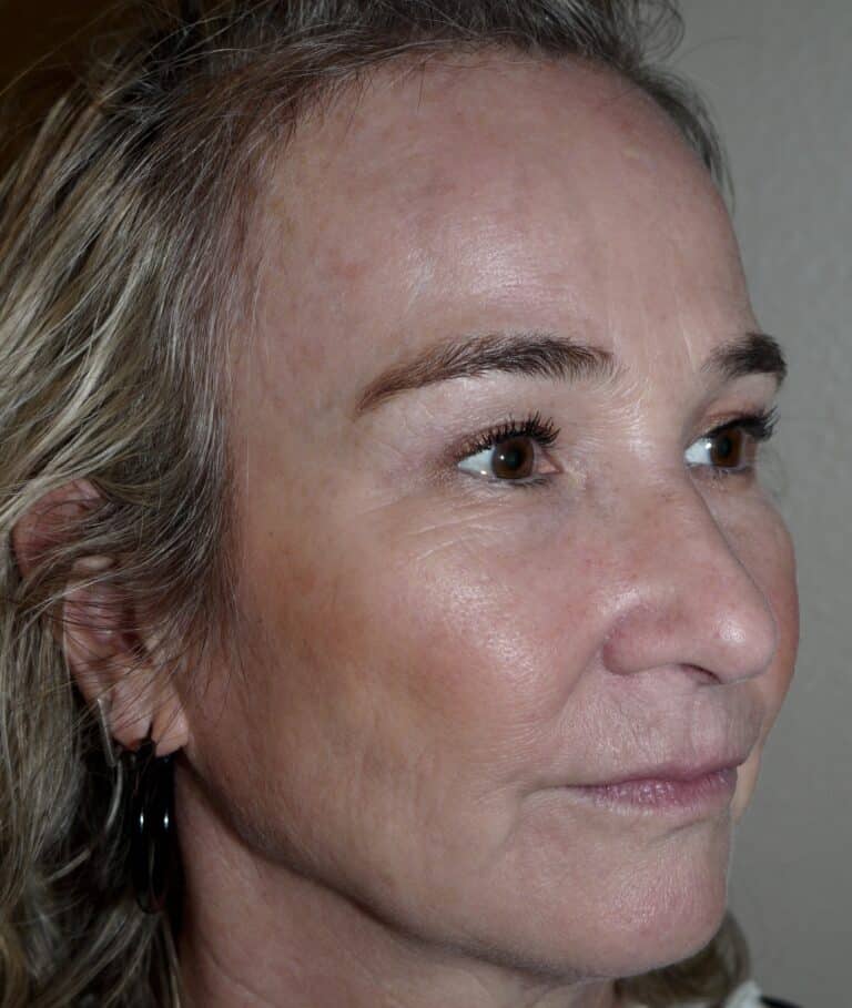 After Image: Forehead Lift - right-front-oblique