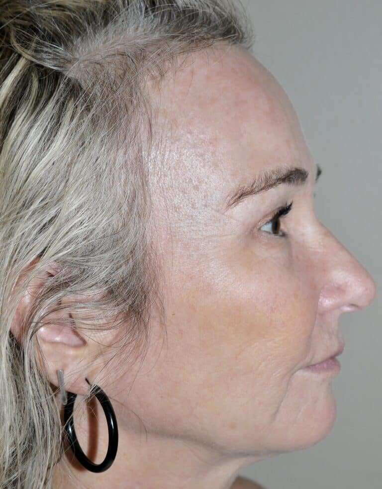 After Image: Forehead Lift - right-side