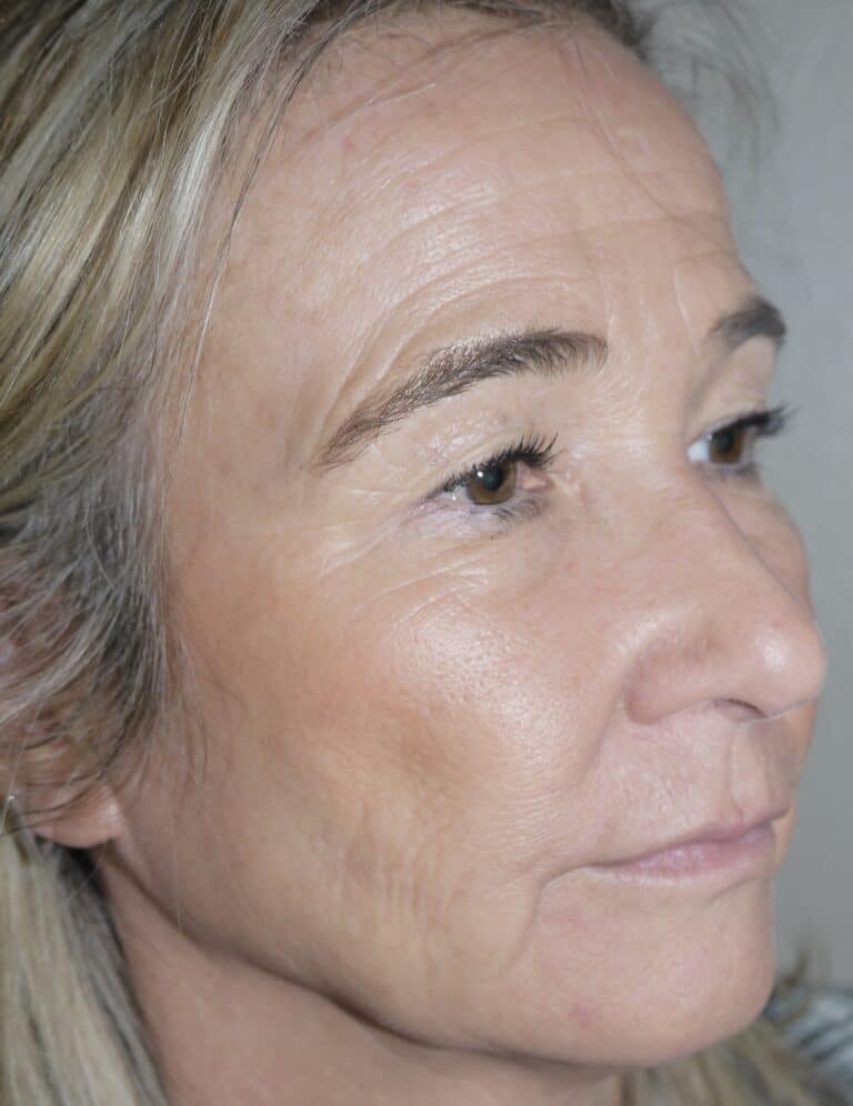 Before Image: Forehead Lift - right-front-oblique