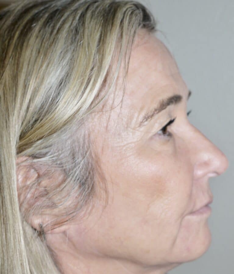 Before Image: Forehead Lift - right-side