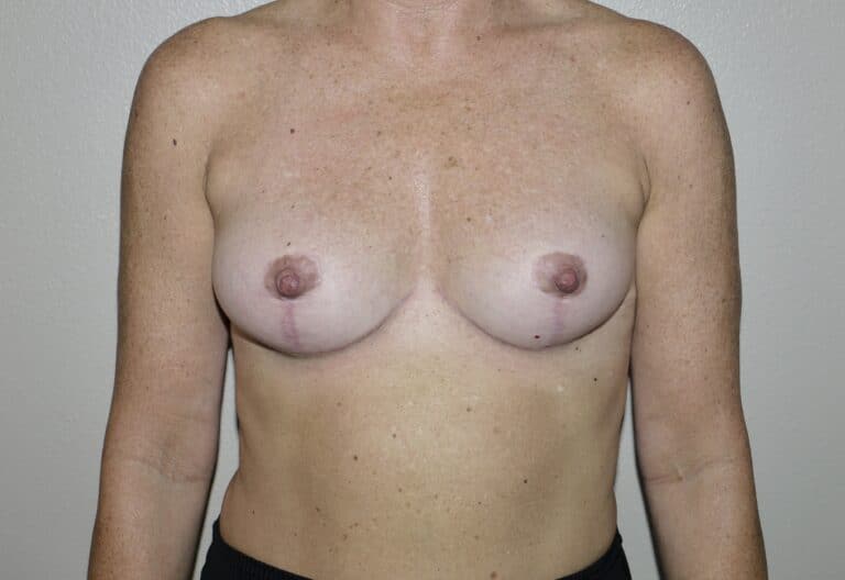 After Image: Breast Implant Removal with Lift - front