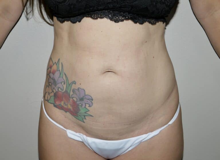 Before Image:  - front