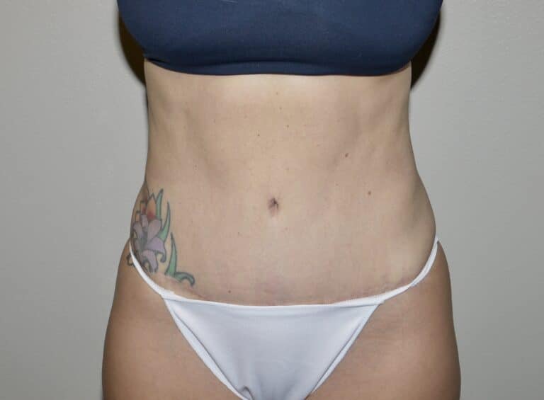 After Image:  - front