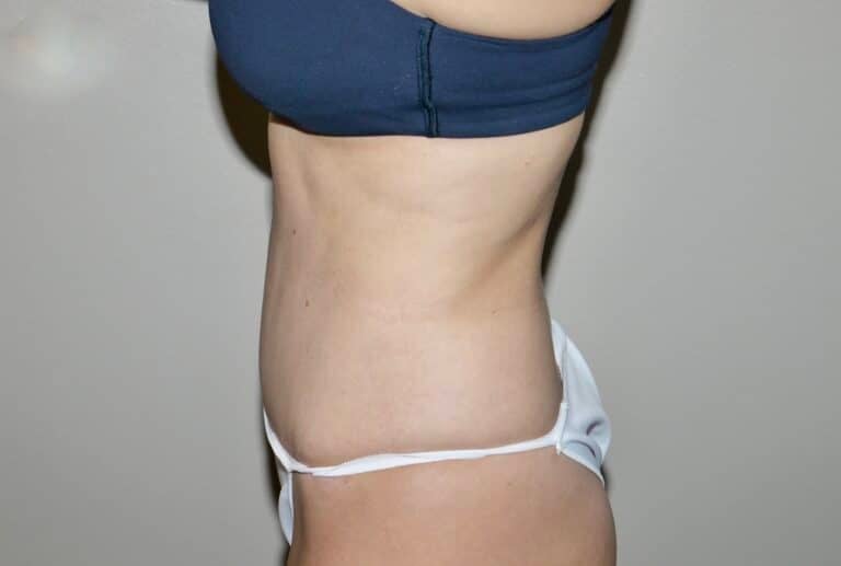 After Image:  - left-side