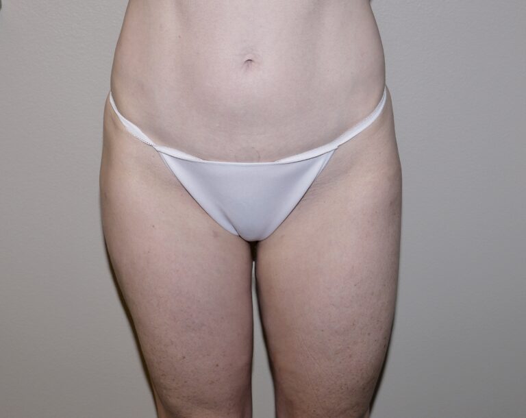 After Image:  - front