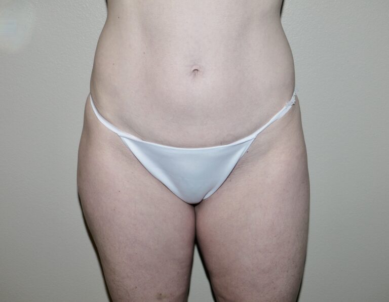 Before Image:  - front
