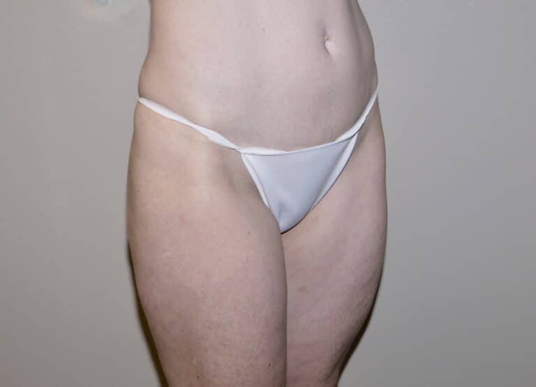 After Image:  - right-front-oblique