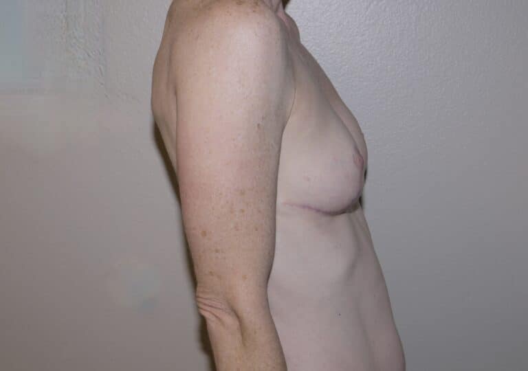After Image: Breast Lift - right-side