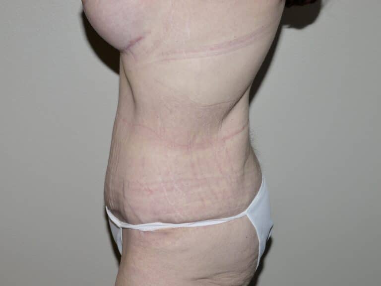 After Image: Abdominoplasty -