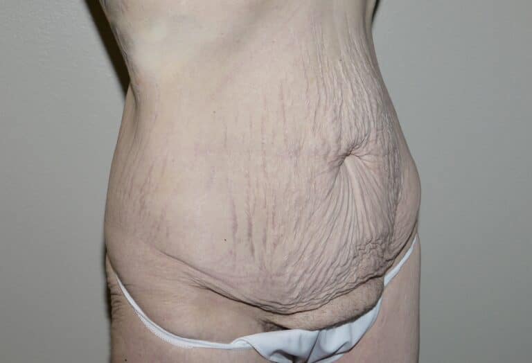 Before Image: Abdominoplasty - right-front-oblique