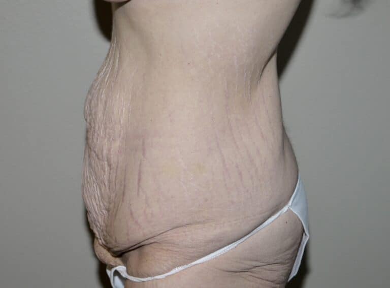 Before Image: Abdominoplasty -