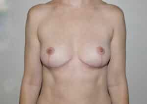 After Image: Breast Implant Removal with Lift