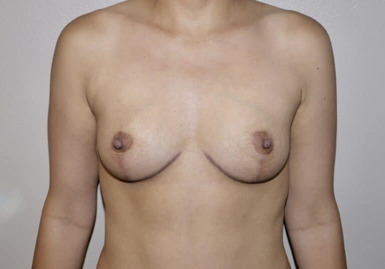 After Image: Breast Lift - front