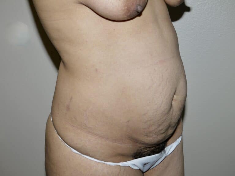 Before Image: Abdominoplasty - right-front-oblique