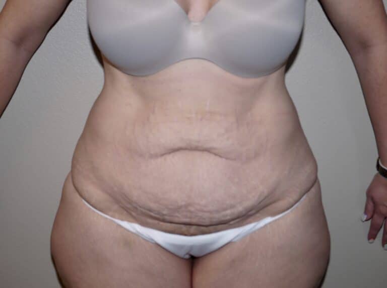 Before Image: Abdominoplasty - front