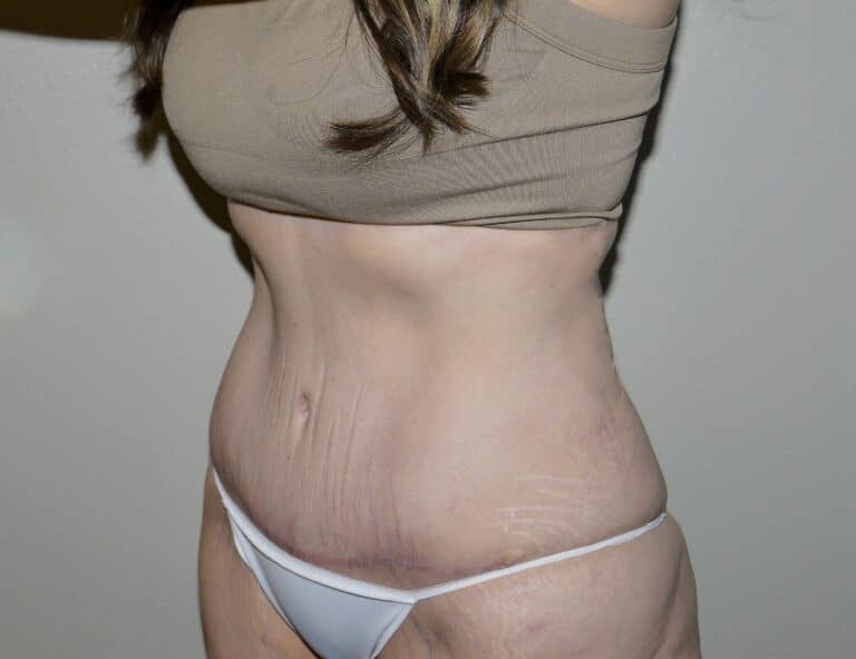 After Image: Abdominoplasty - left-front-oblique