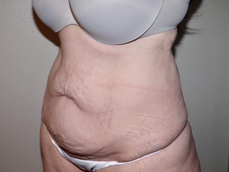 Before Image: Abdominoplasty - left-front-oblique