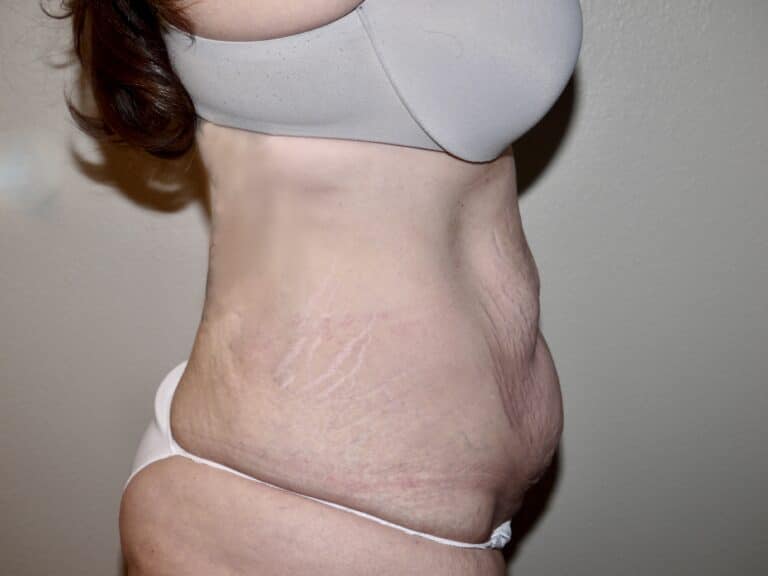 Before Image: Abdominoplasty - right-side