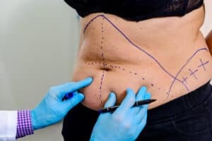 Doctor marking up patient's stomach for a tummy tuck procedure