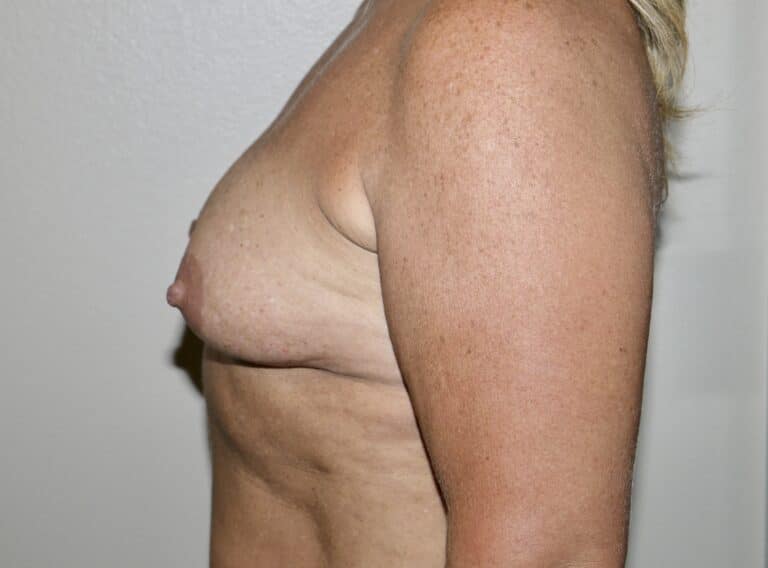 Before Image: Breast Augmentation - left-side
