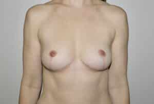 After Image: Breast Implant Removal with Lift
