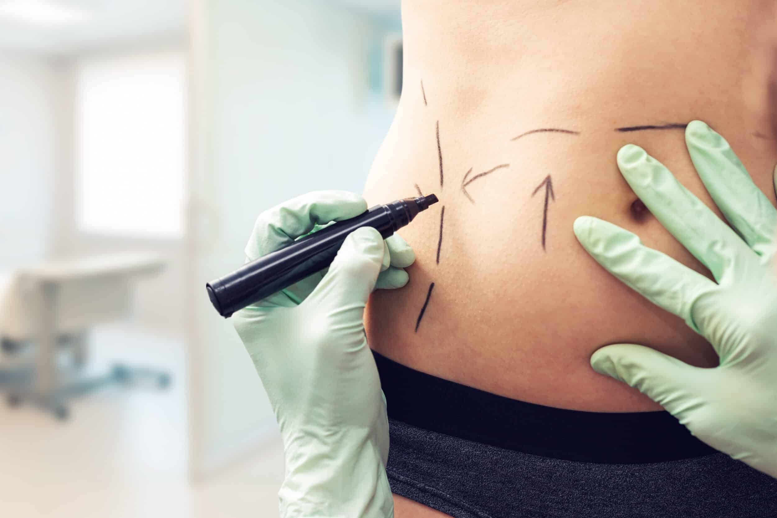 Woman preparing for abdominoplasty procedure, concept of tummy tuck surgery and abdominal contouring