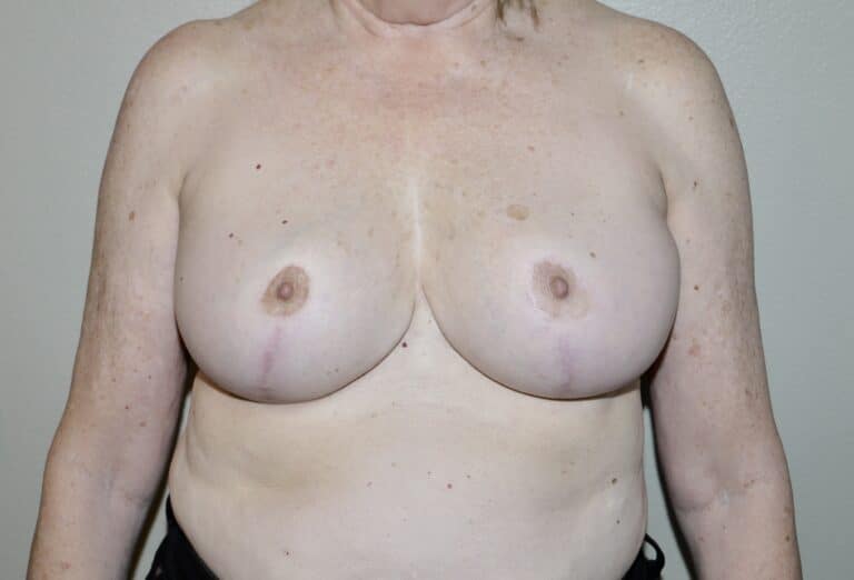 After Image: Breast Reduction - front