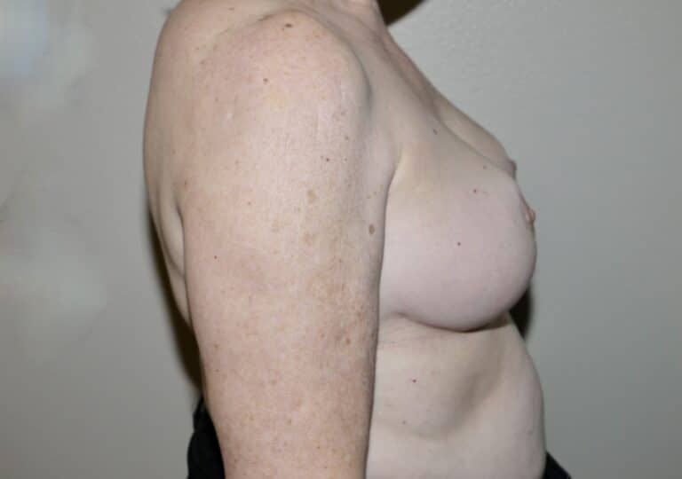 After Image: Breast Reduction - right-side