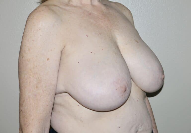 Before Image: Breast Reduction - right-front-oblique