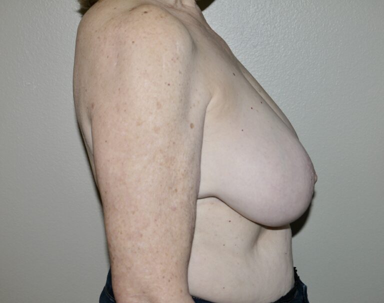 Before Image: Breast Reduction - right-side