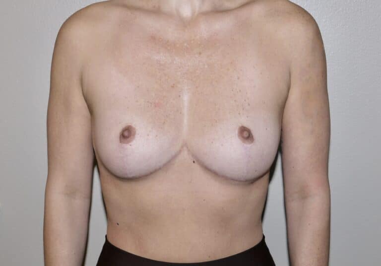 After Image: Breast Implant Removal with Lift - front