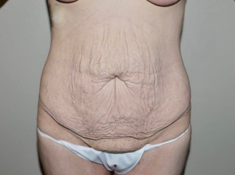 Before Image: Abdominoplasty - front