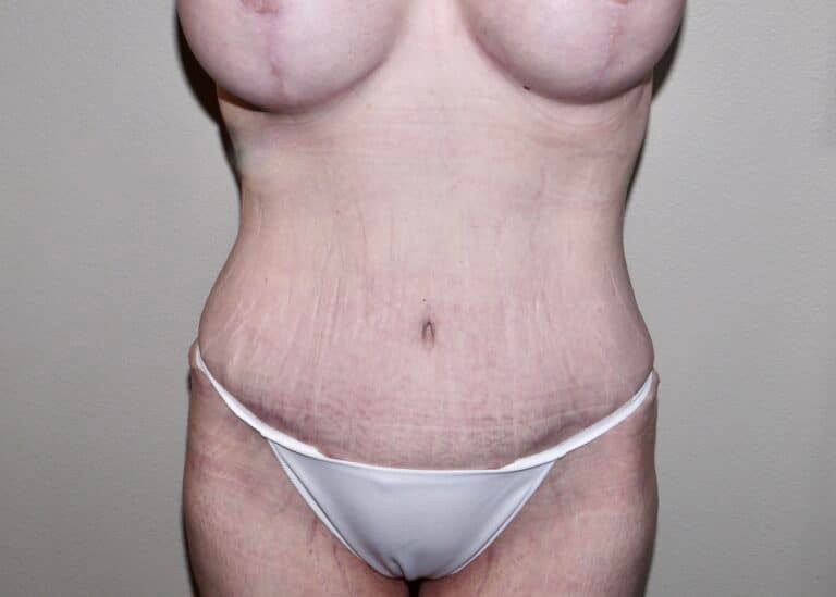 After Image: Abdominoplasty - front