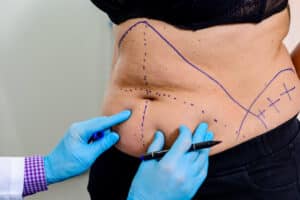 plastic surgeon marking up woman's stomach for liposuction procedure