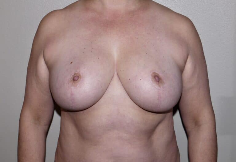 After Image: Breast Reduction - front