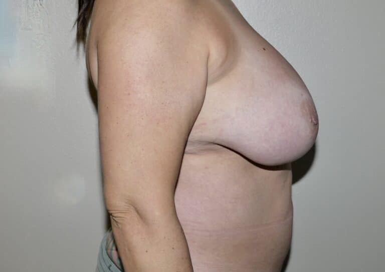 Before Image: Breast Reduction - right-side