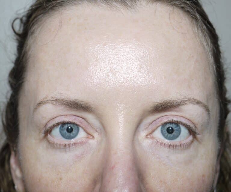 After Image: Eyelid Surgery - front