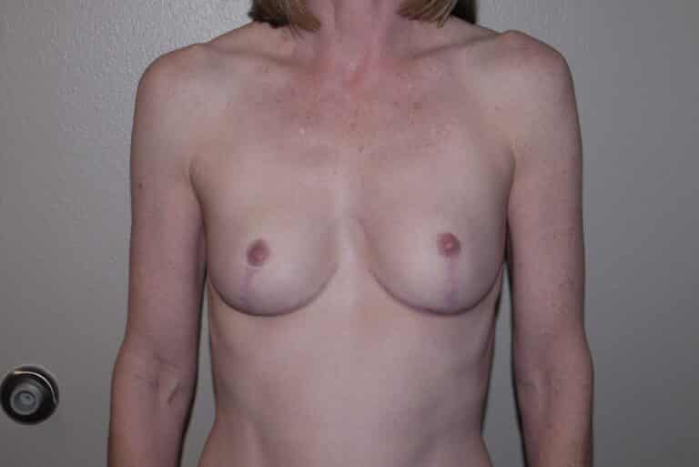 After Image: Breast Lift - front