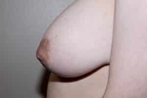 After Image: Nipple Reduction