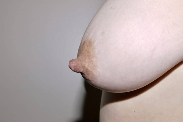 Before Image: Nipple Reduction - left-side