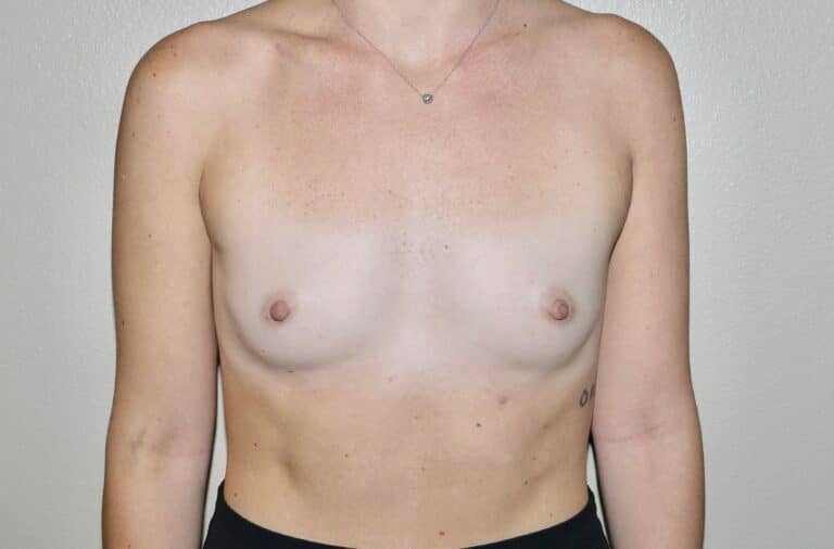 Before Image: Breast Augmentation - front