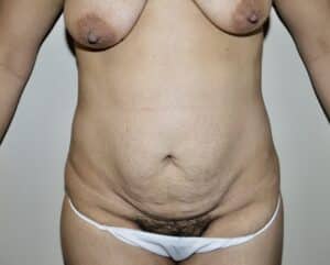 Before Image: Abdominoplasty
