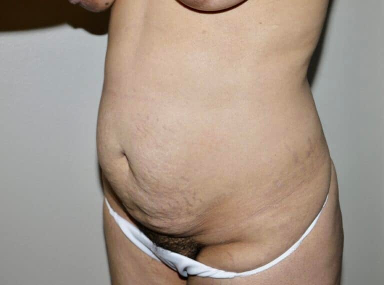 Before Image: Abdominoplasty - left-front-oblique