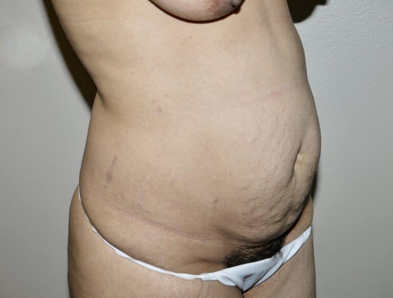 Before Image: Abdominoplasty - right-front-oblique