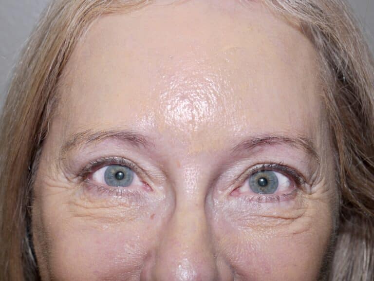 After Image: Forehead Lift - front