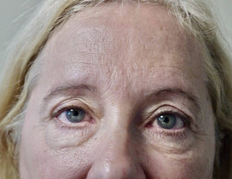 Before Image: Forehead Lift - front